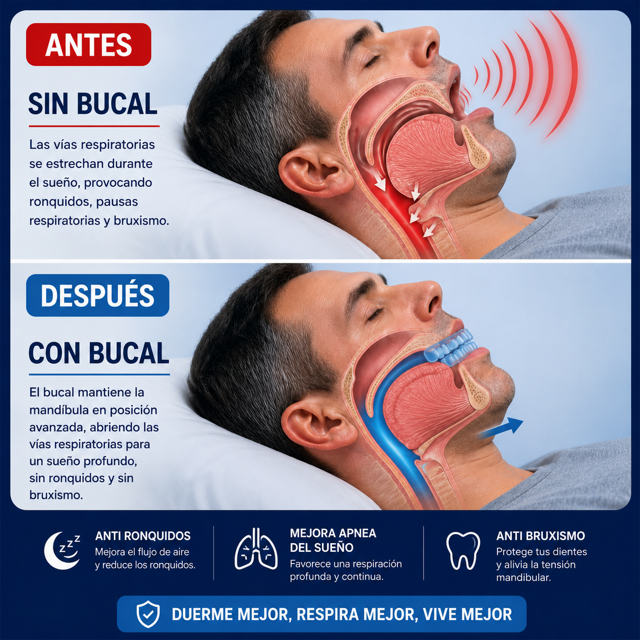 Férula bucal antironquídos